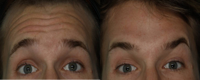 Botox before and after photo