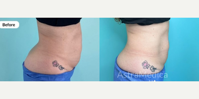 CoolSculpting before and after photo