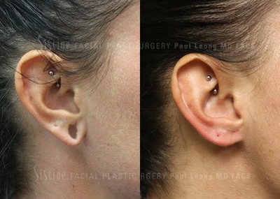Earlobe Repair before and after photo