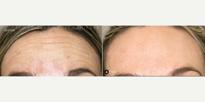 Botox before and after photo