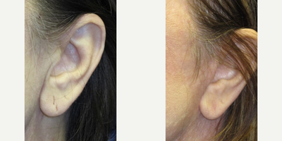 Ear Surgery before and after photo