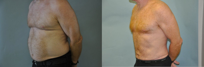 Male Tummy Tuck before and after photo