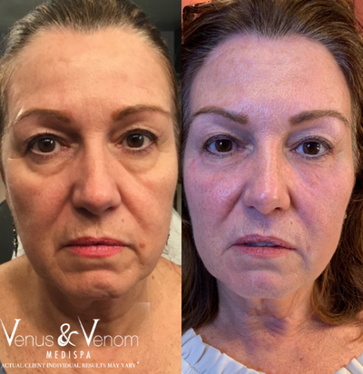 Restylane before and after photo