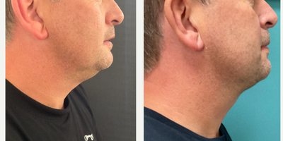 Chin Liposuction before and after photo