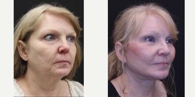 Deep Plane Facelift before and after photo