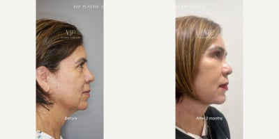 Facial Fat Transfer before and after photo