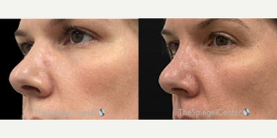 Dermal Fillers before and after photo