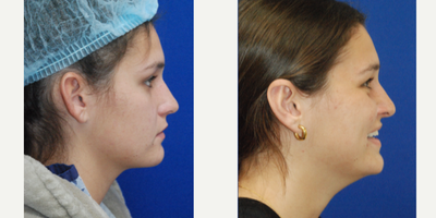 Ear Surgery before and after photo