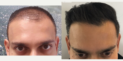 FUE Hair Transplant before and after photo