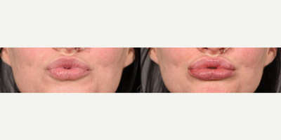 Juvederm before and after photo