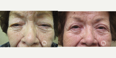 Eyelid Surgery before and after photo