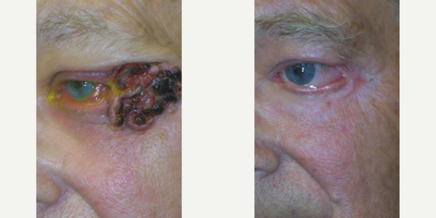 Mohs Surgery before and after photo