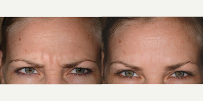 Dysport before and after photo