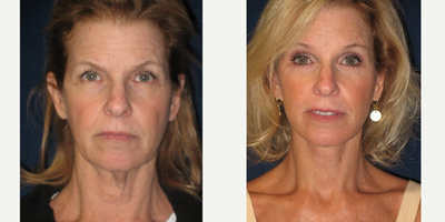 Facelift before and after photo