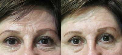 Laser Resurfacing before and after photo