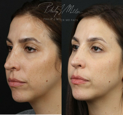 Revision Rhinoplasty before and after photo