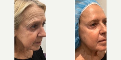 RHA Collection Fillers before and after photo
