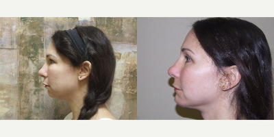 Chin Implant before and after photo