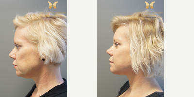 Facelift before and after photo