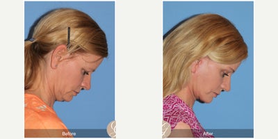 Lower Facelift before and after photo