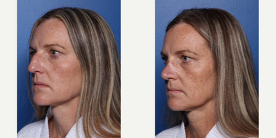 Rhinoplasty before and after photo