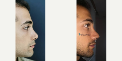 Rhinoplasty before and after photo