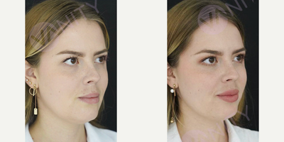 Dermal Fillers before and after photo