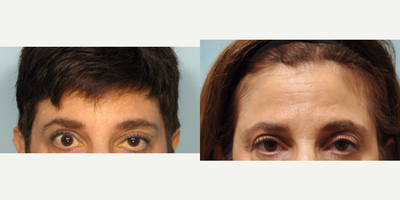 Eyelid Surgery before and after photo