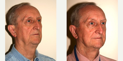 Mini Facelift before and after photo