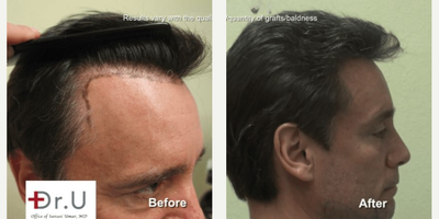 Hair Transplant before and after photo
