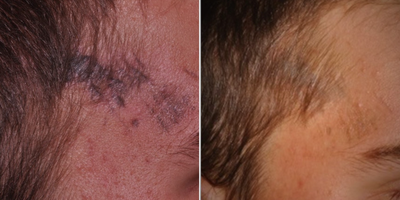 Laser Scar Removal before and after photo