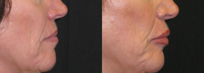 Lip Fillers before and after photo