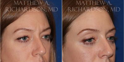 Botox before and after photo
