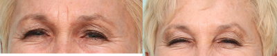 Botox before and after photo