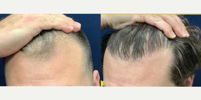 Hair Transplant before and after photo