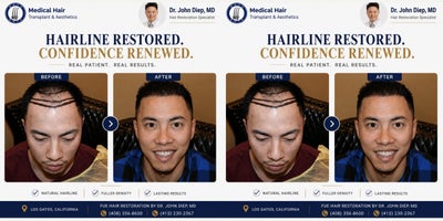 Hair Transplant before and after photo