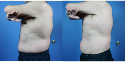 CoolSculpting before and after photo