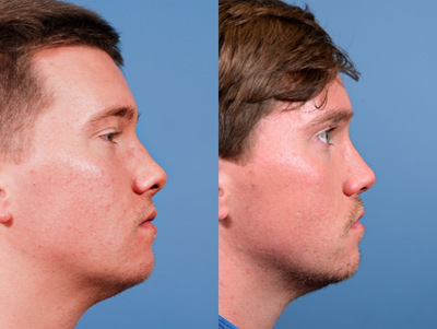 Revision Rhinoplasty before and after photo