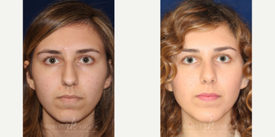 Chin Implant before and after photo