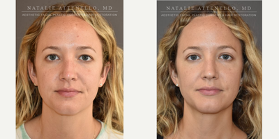 Double Eyelid Surgery before and after photo