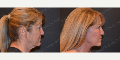Facelift before and after photo