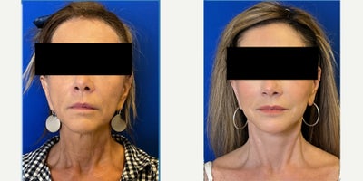 before and after image