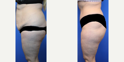 Liposuction before and after photo