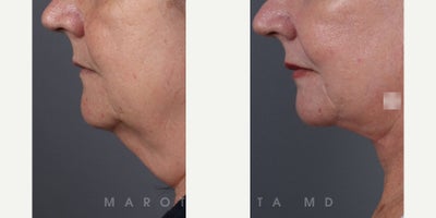 Neck Lift before and after photo