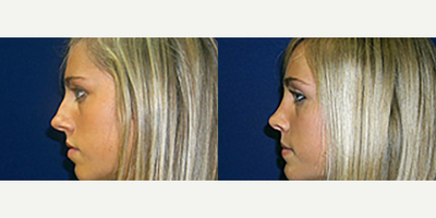 Rhinoplasty before and after photo