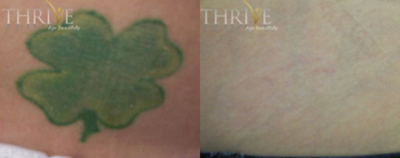 Tattoo Removal before and after photo