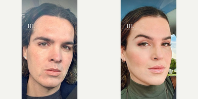 Cheek Augmentation before and after photo