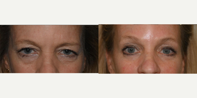 Eyelid Surgery before and after photo