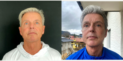 Facelift before and after photo