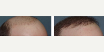 Hair Transplant before and after photo